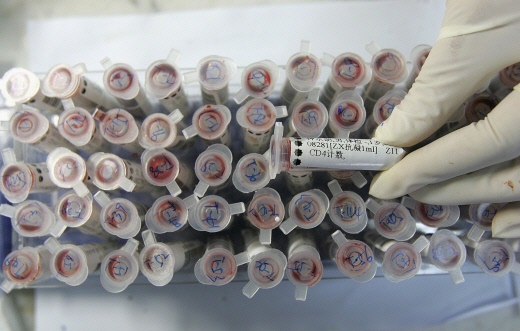 HIV 테스트 샘플. | Getty Images
