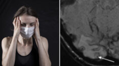 7년 동안 두통 호소하던 호주 여성, 원인은 뇌 속에 자라던 ‘기생충’이었다