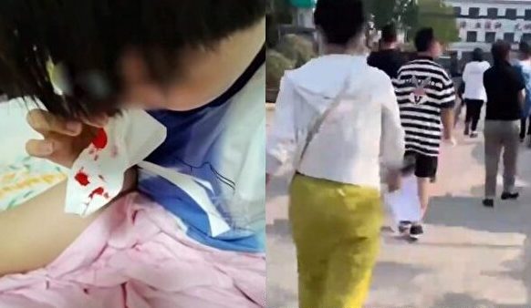 중국 허난성 상추시의 한 마을에서 어린이 100여명이 집단으로 코피를 흘리는 사태가 발생했다. 사진은 코피가 나자 휴지로 진정시키는 아이 | 웨이보