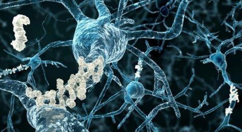 알츠하이머병 환자의 뇌 신경 | 연합뉴스