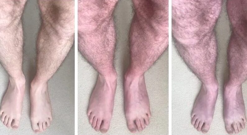 영국에 거주하는 33세 남성 환자에게서 발견된 푸른 다리 증후군 | 영국 리즈 대학교 제공